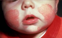 小儿湿疹的治疗方法