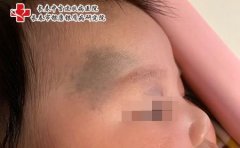 长春激光蒙古斑注意:婴儿身上的蒙古斑