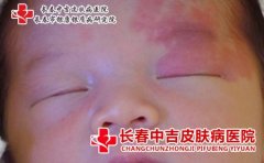 新生儿红色胎记的辨别和形成的原因